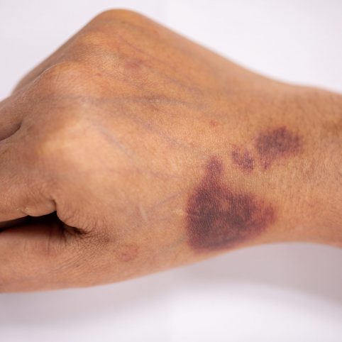 Photo of Bruised hand